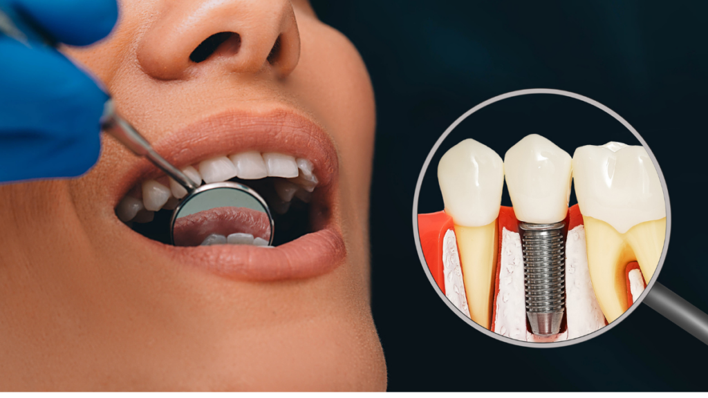 implante dentario pelo sus